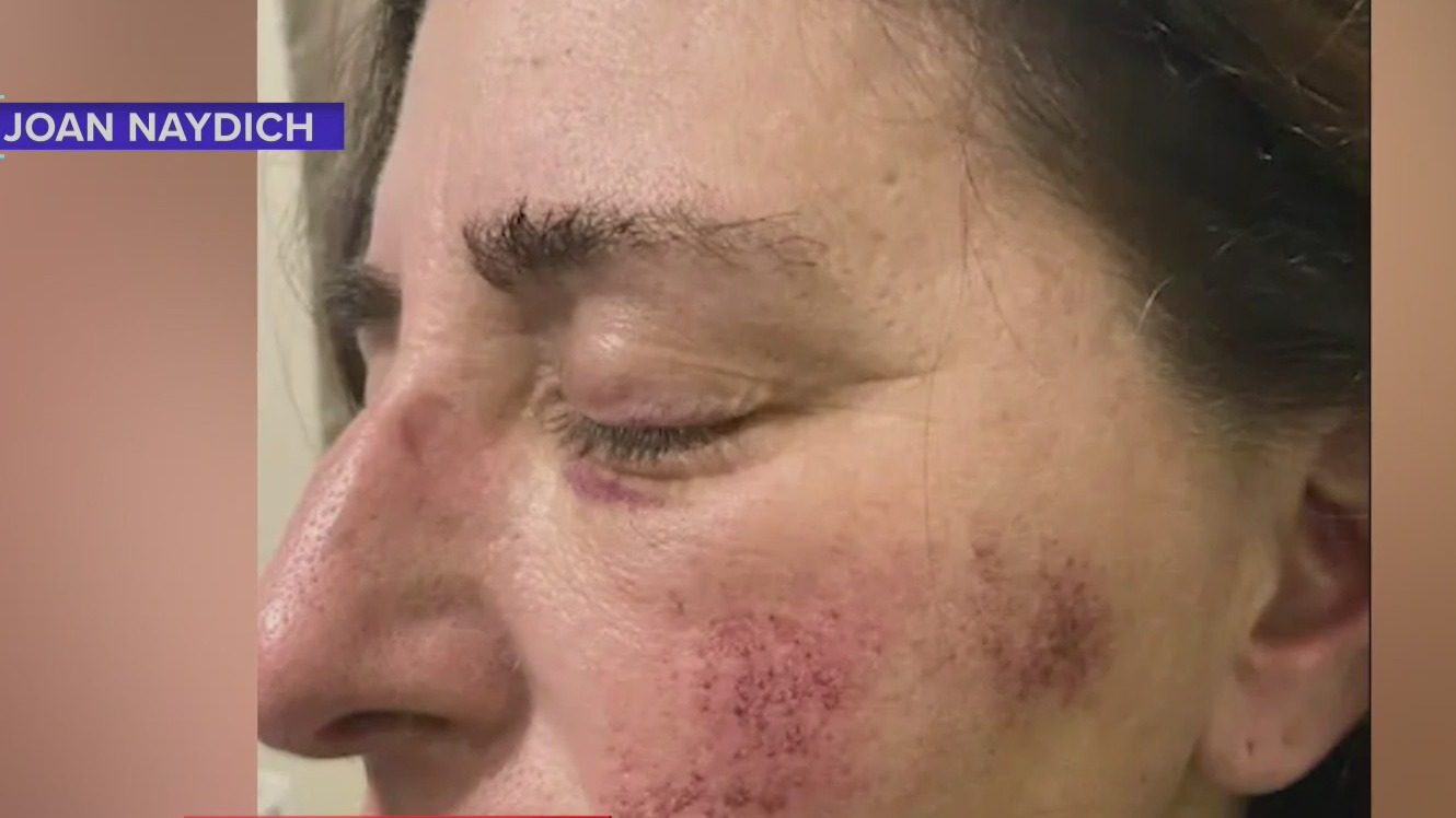 Image of Joan Naydich, showing injuries she received in a beating by a high school student in February of 2023.