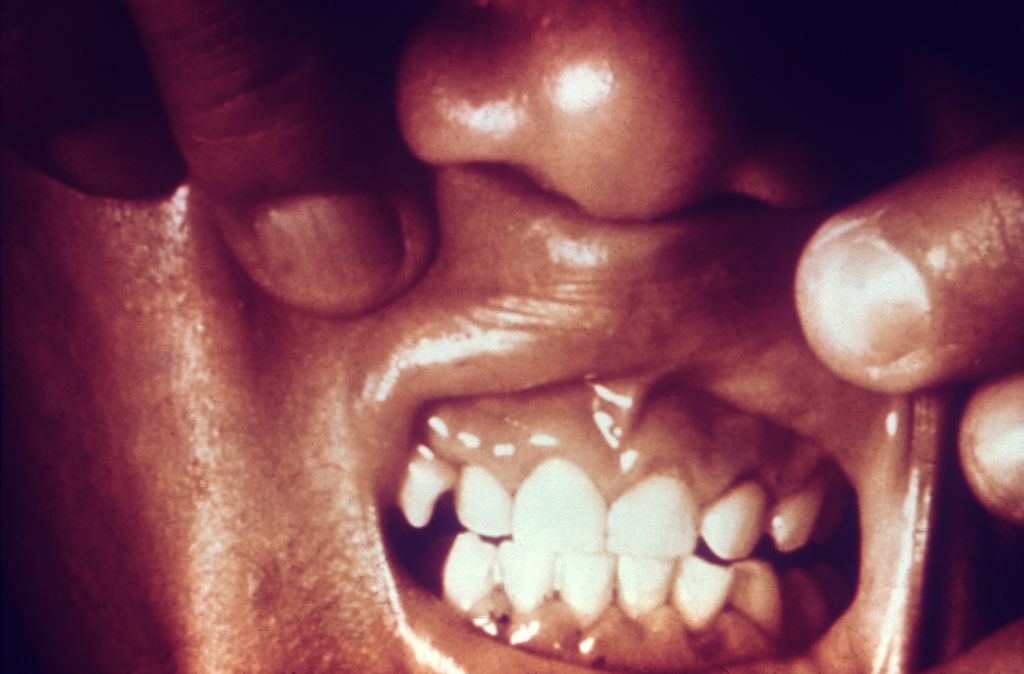 An image of a patient with inflamed gums due to a vitamin C deficiency.