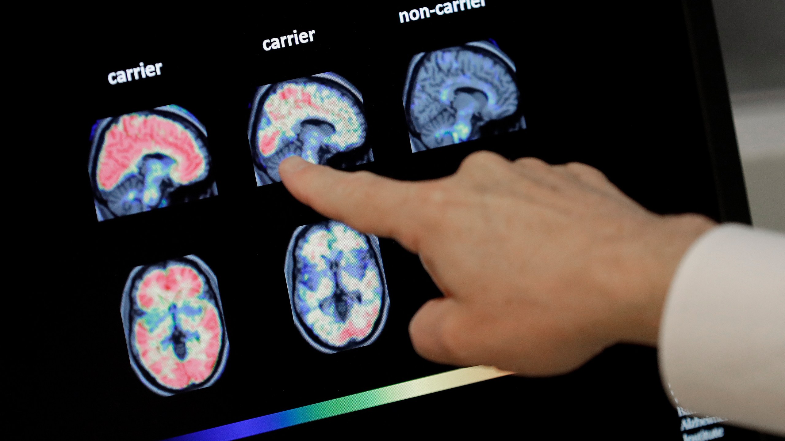 A doctor points to scans of a brain