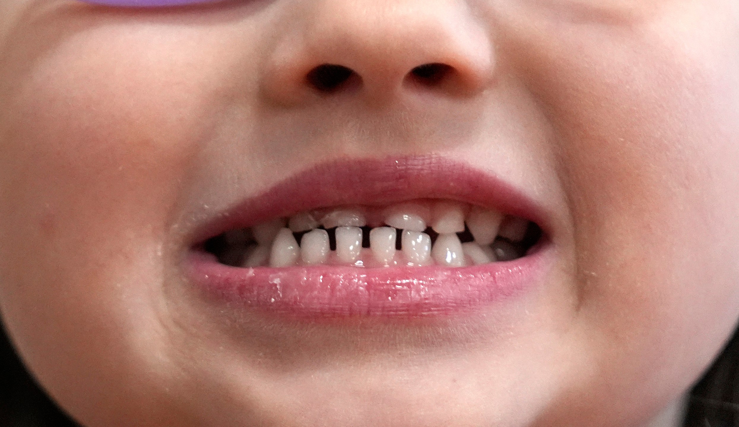 FILE - A child shows off her teeth after a dental exam in Concord, N.H., Wednesday, Feb. 21, 2024. (AP Photo/Robert F. Bukaty, file)
