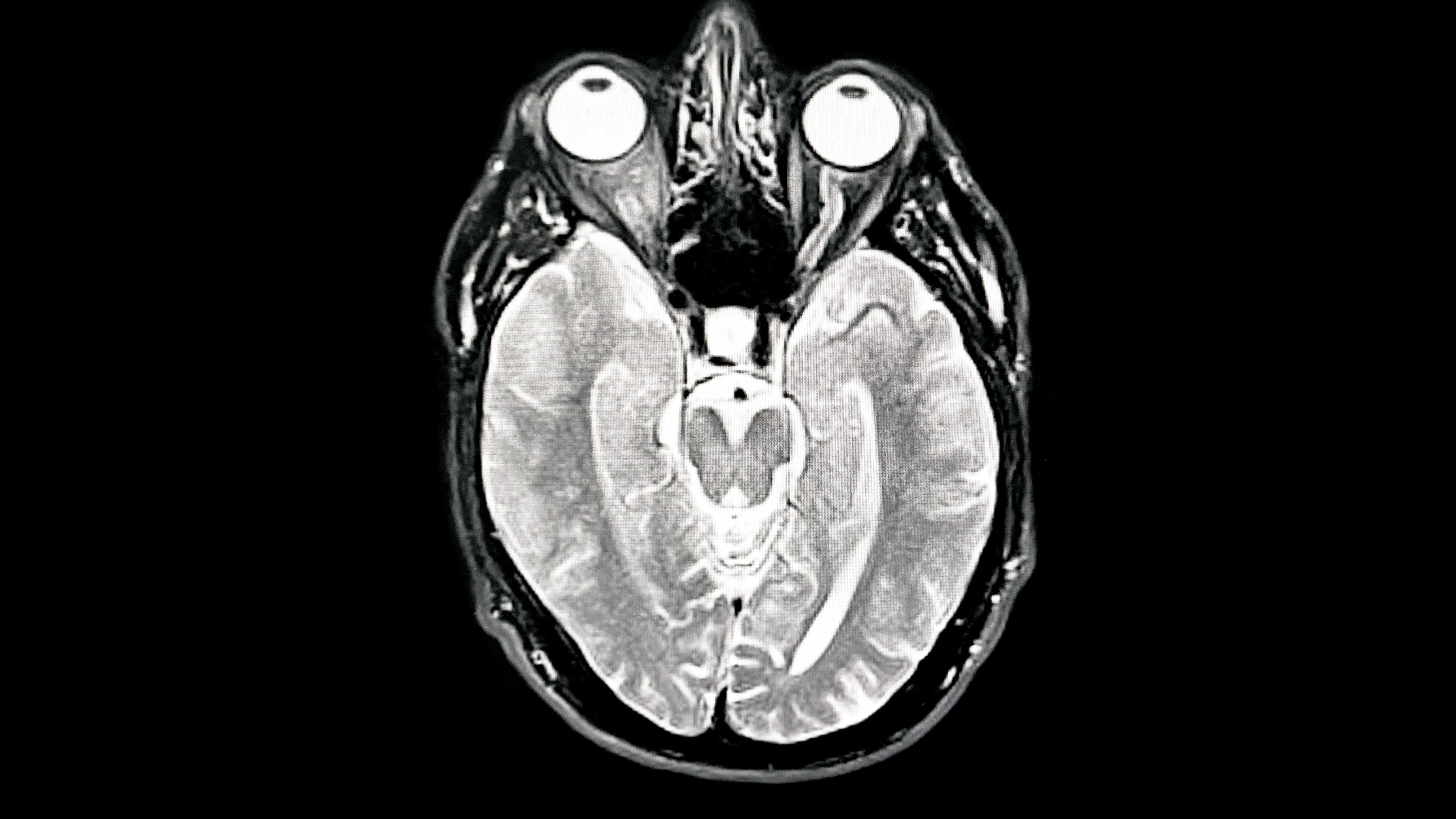 An artificially-intelligence pen can help reveal early signs of Parkinson's disease in people.