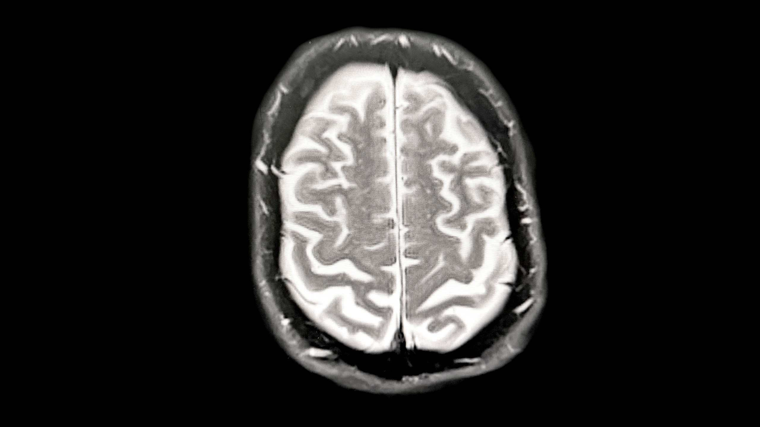 black and white scan of brain with Alzheimer's