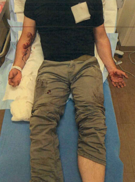 Injuries sustained by the ICE officer in a June incident