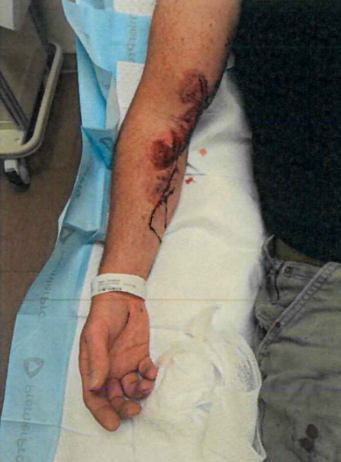 Injuries sustained by the ICE officer in a June incident