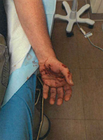 Injuries sustained by the ICE officer in a June incident